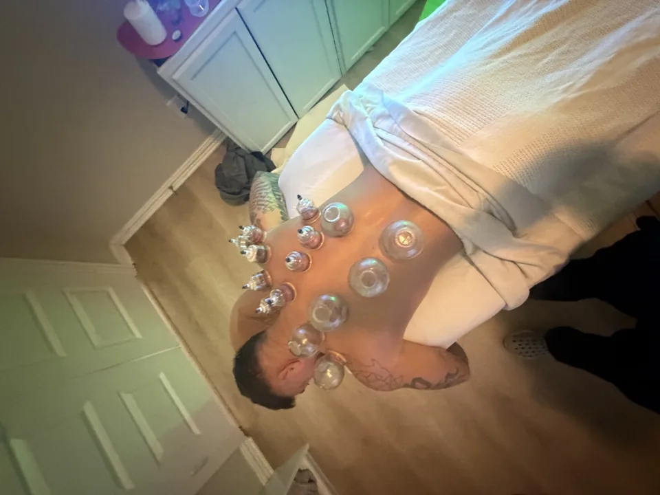 Intrinsic Hands treatment photograph: cupping session 1