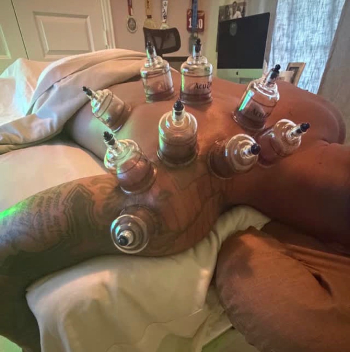 Cupping therapy session