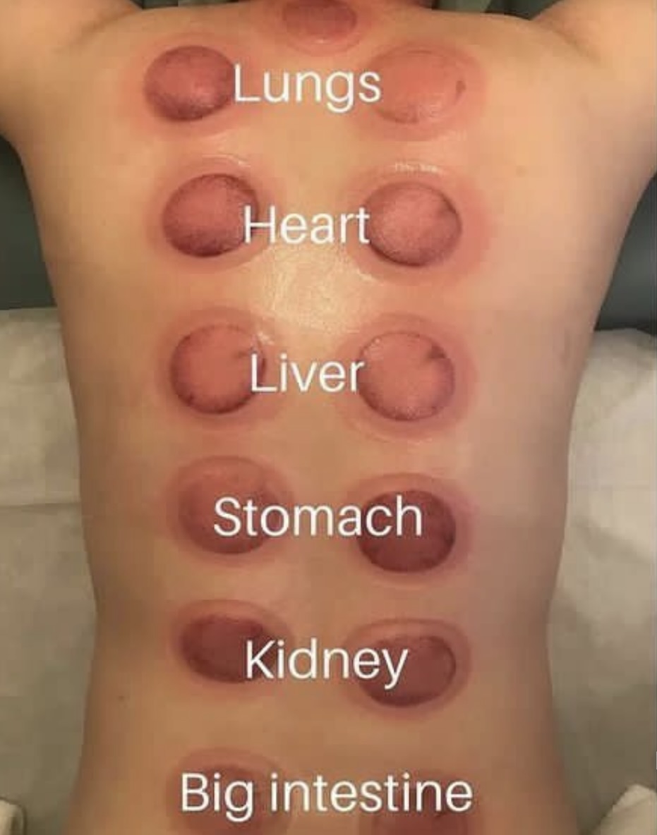 Cupping therapy zones